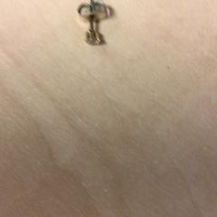 Oorknopje, jak nahlášeno Haaglanden Medisch Centrum pomocí iLost